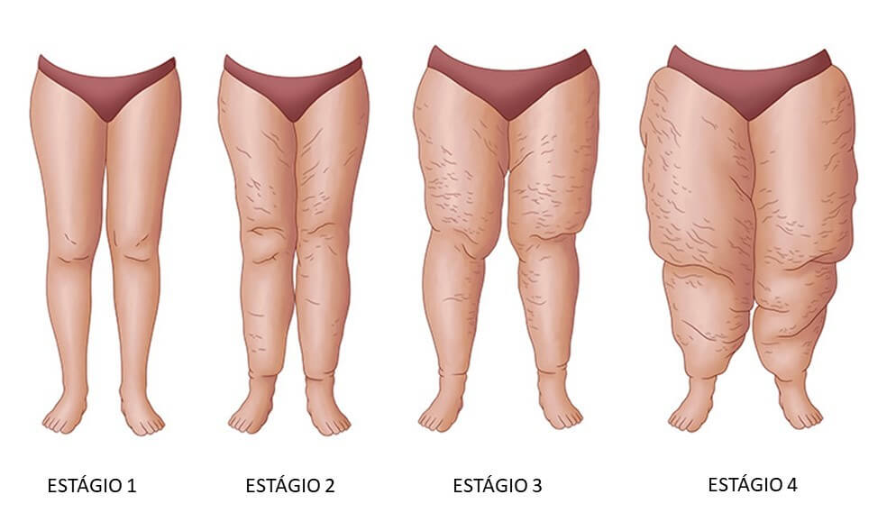 Lipedema: Entenda a Condição, Seus Sintomas e Tratamentos